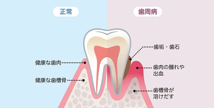 歯がボロボロでお悩みの方歯がグラグラしてしまっている方