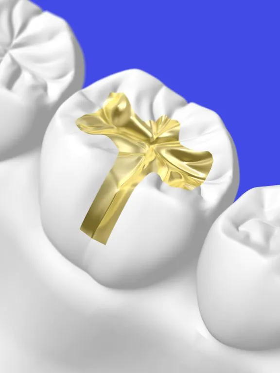 ゴールド・PGAインレー